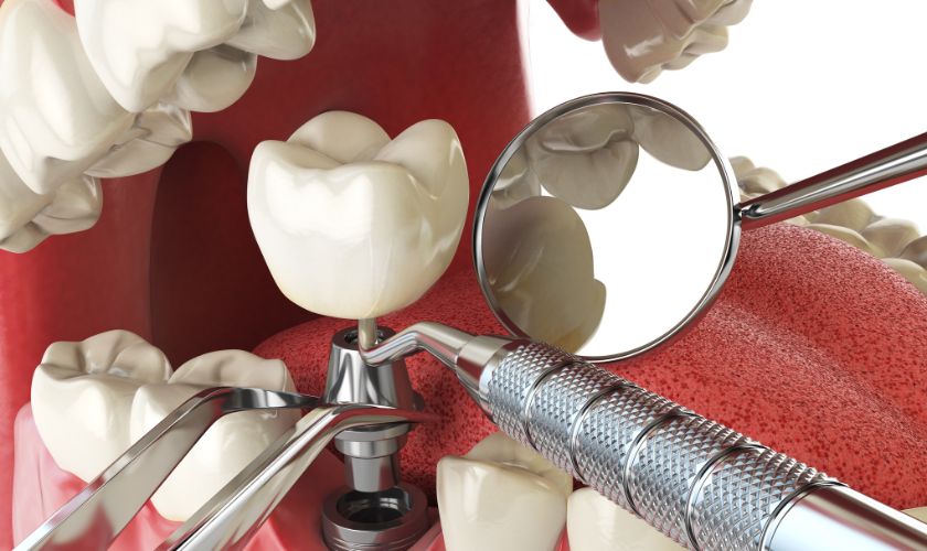 Compelling Reasons to Consider Dental Implants: A Guide for Parker Residents