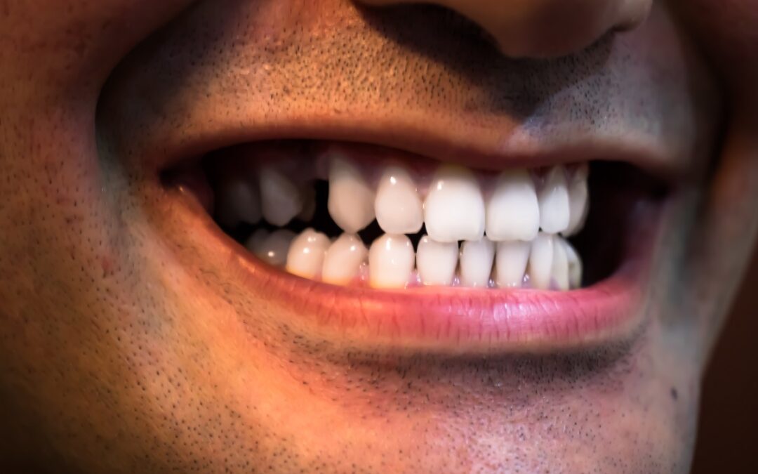 Biggest mistake after tooth extraction