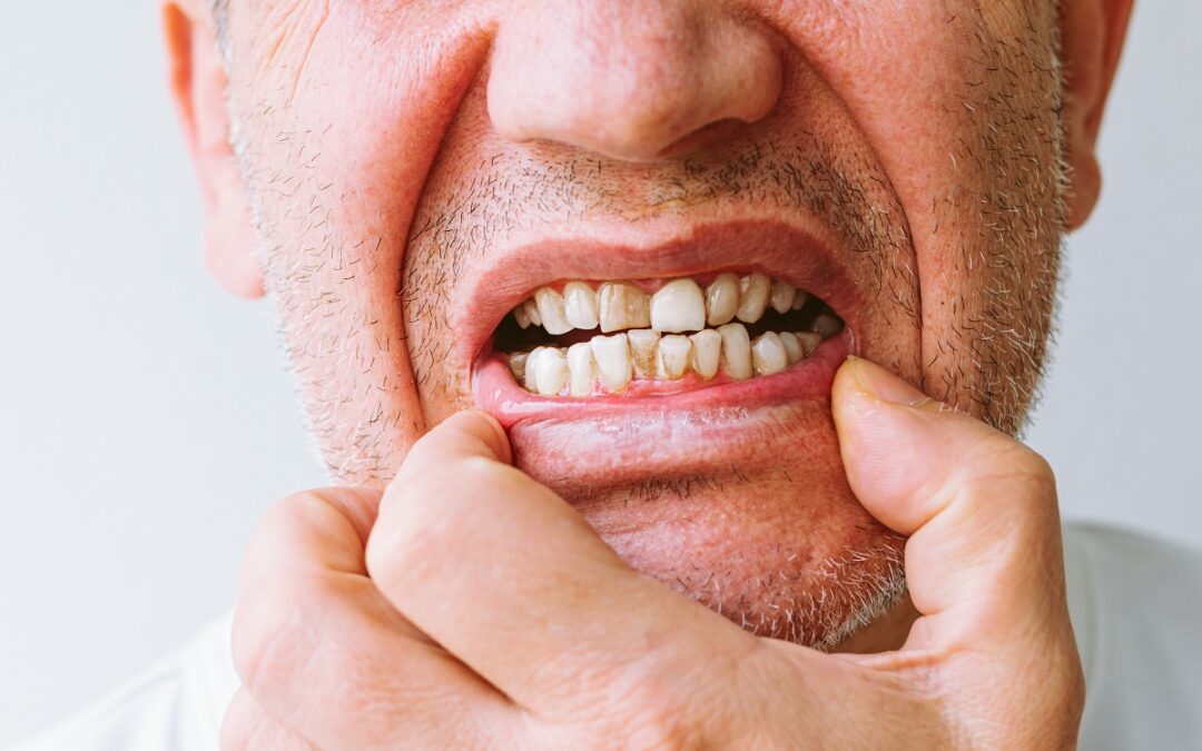 Can enamel erosion be reversed